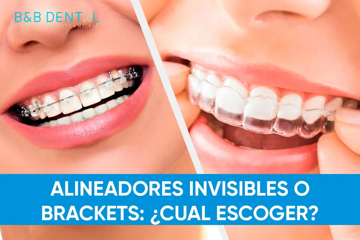 Alineadores invisibles o brackets: ¿cuál escoger?
