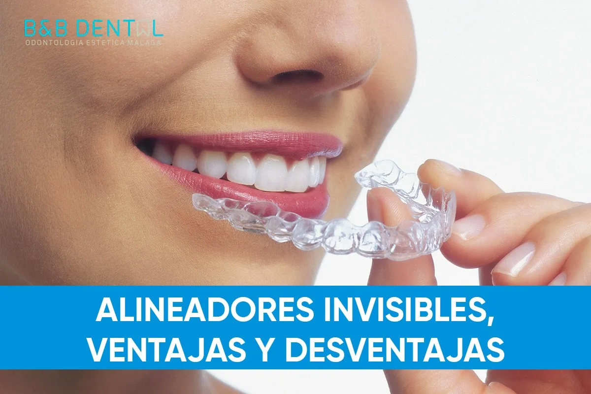 Alineadores invisibles, ventajas y desventajas