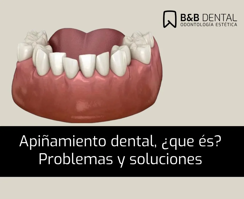Apiñamiento dental: qué es, por qué ocurre y cómo se soluciona