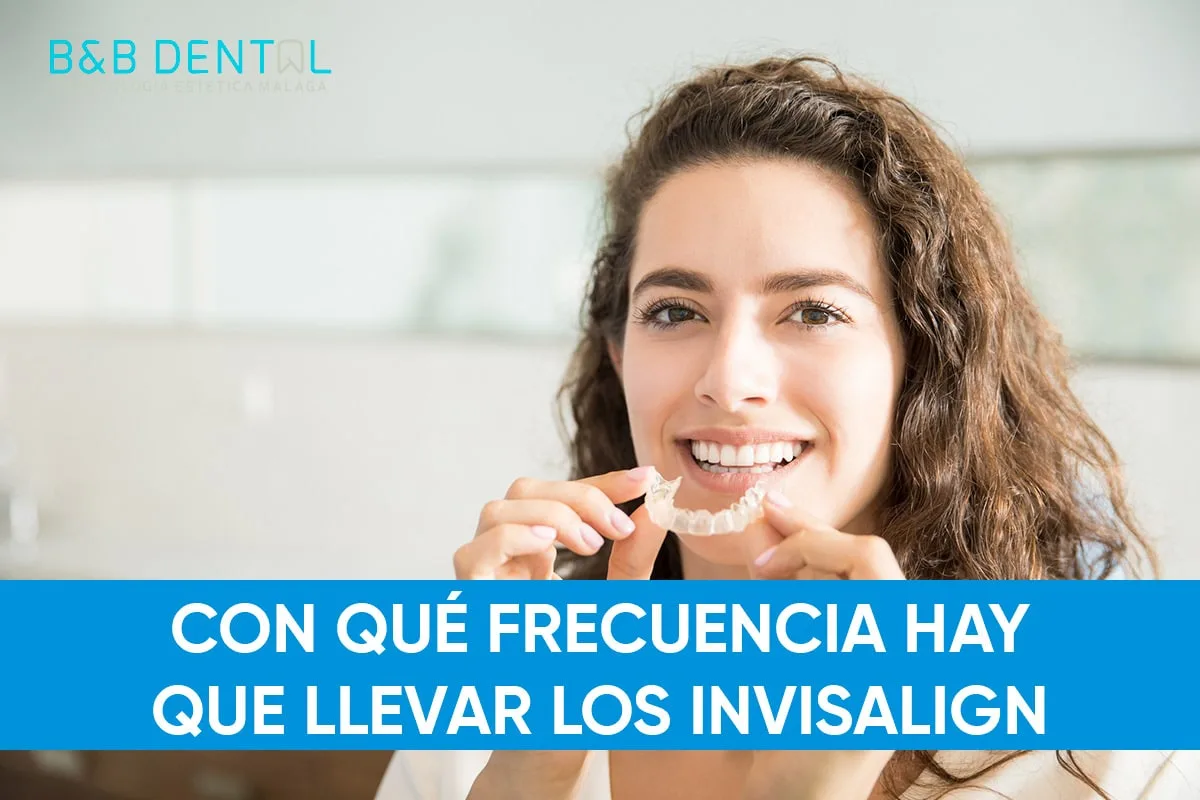 ¿Con qué frecuencia hay que llevar los alineadores Invisalign?