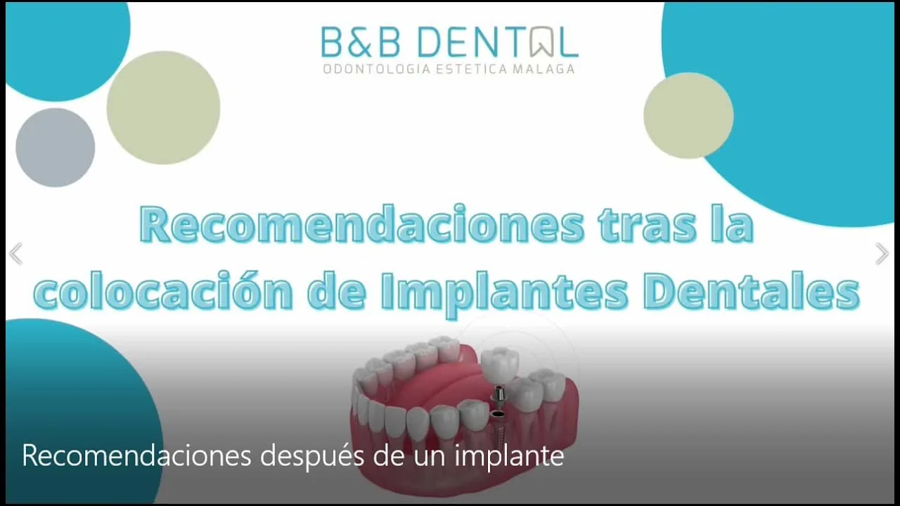 Consejos para el cuidado de los implantes dentales