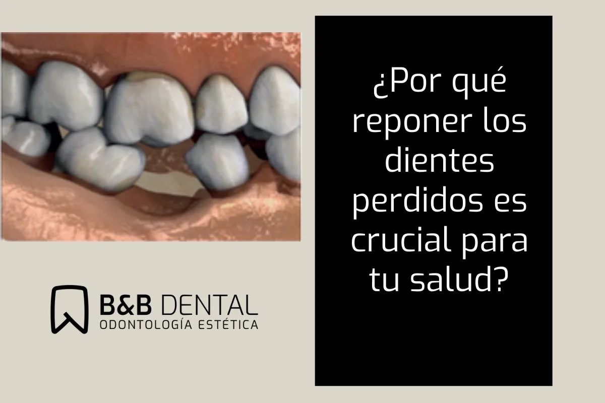 ¿Por qué reponer los dientes perdidos es crucial para tu salud?