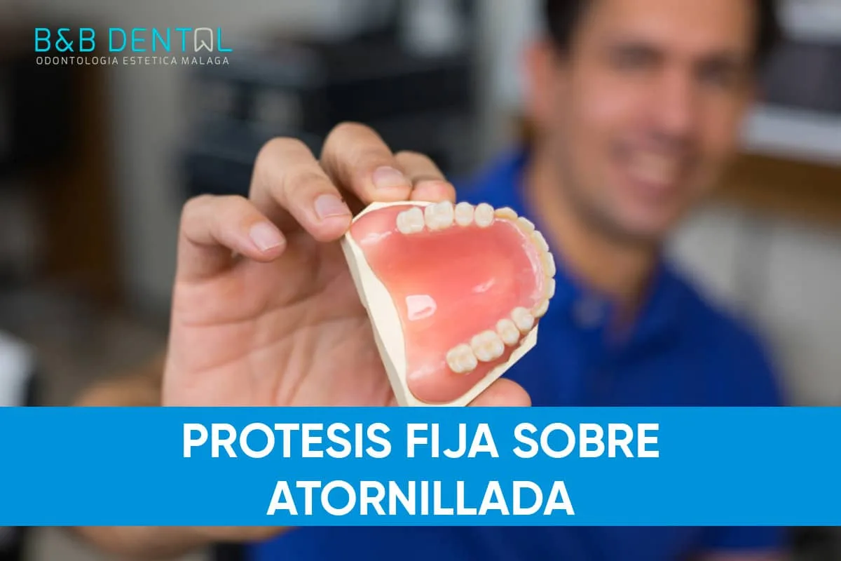 Prótesis fija sobre implantes atornillada, todo lo que debes saber