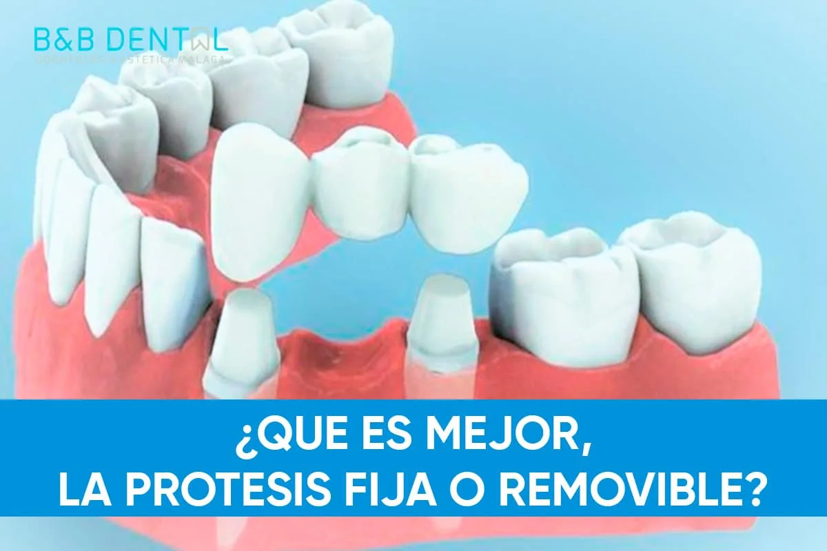 ¿Qué es mejor prótesis dental fija o removible?
