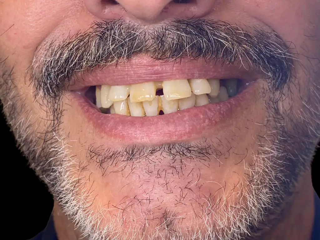 Before padi children's dentist in málaga treatment at ByB Dental