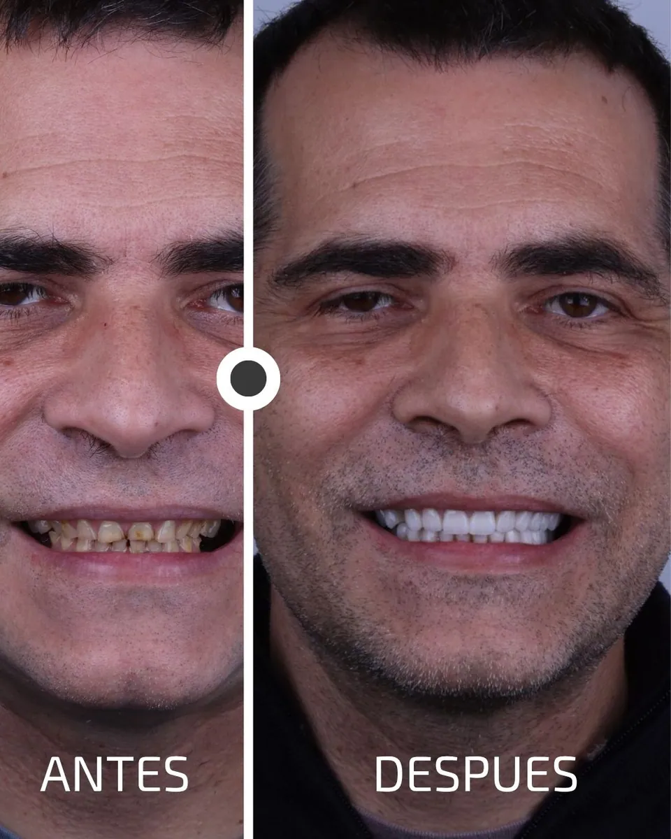 Caso real de transformación dental ByB Dental 1