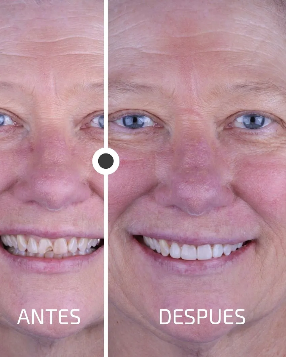 Caso real de transformación dental ByB Dental 10