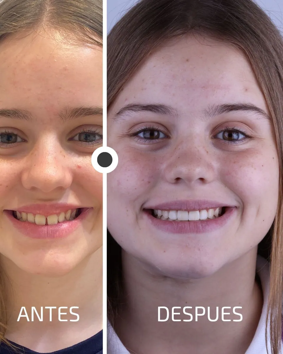 Caso real de transformación dental ByB Dental 11