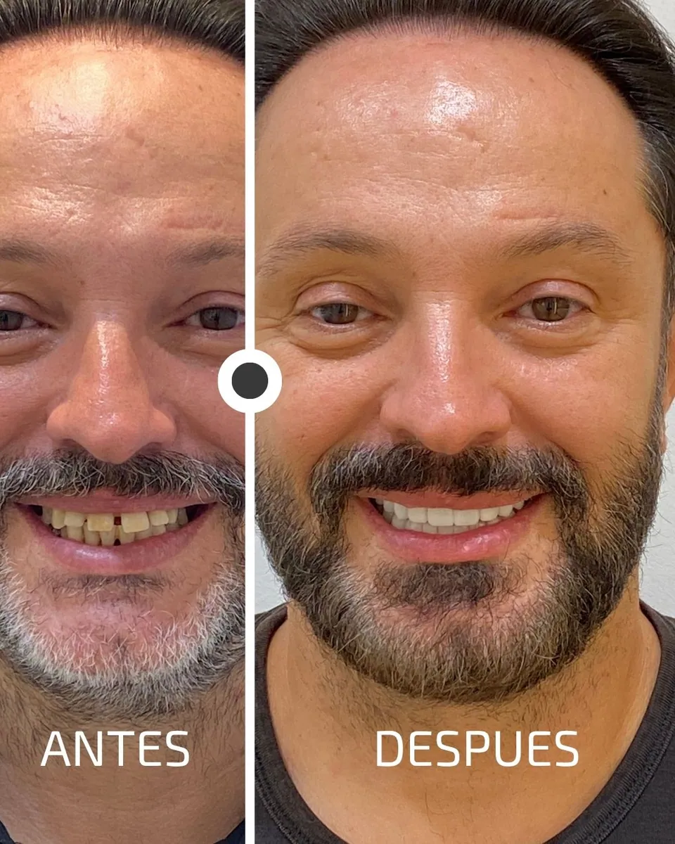 Caso real de transformación dental ByB Dental 12
