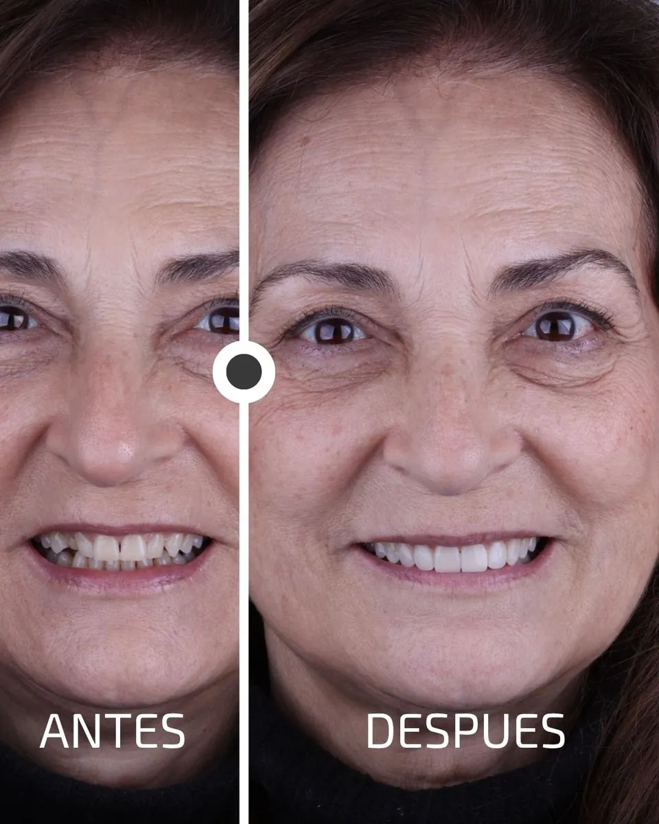 Caso real de transformación dental ByB Dental 13