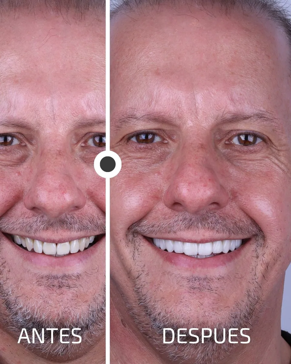 Caso real de transformación dental ByB Dental 14