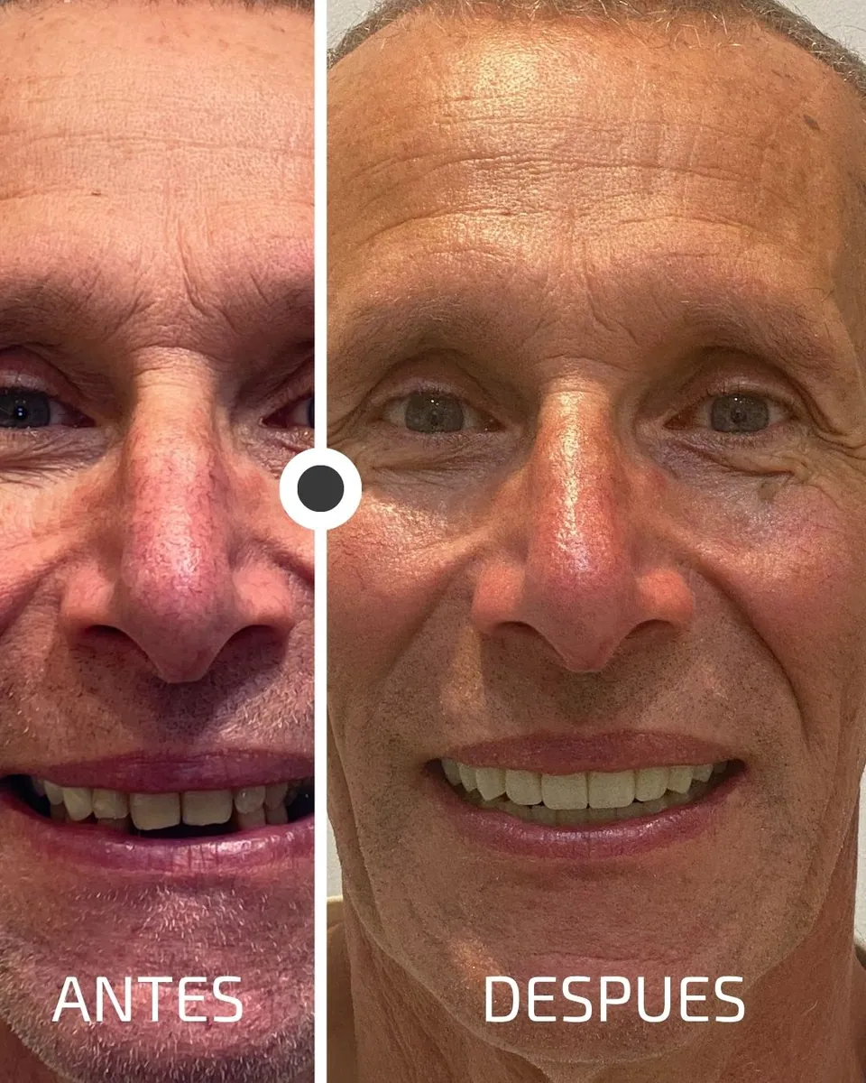 Caso real de transformación dental ByB Dental 15