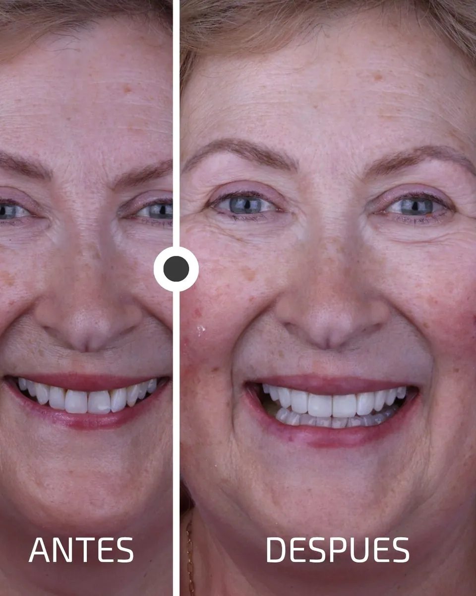 Caso real de transformación dental ByB Dental 17