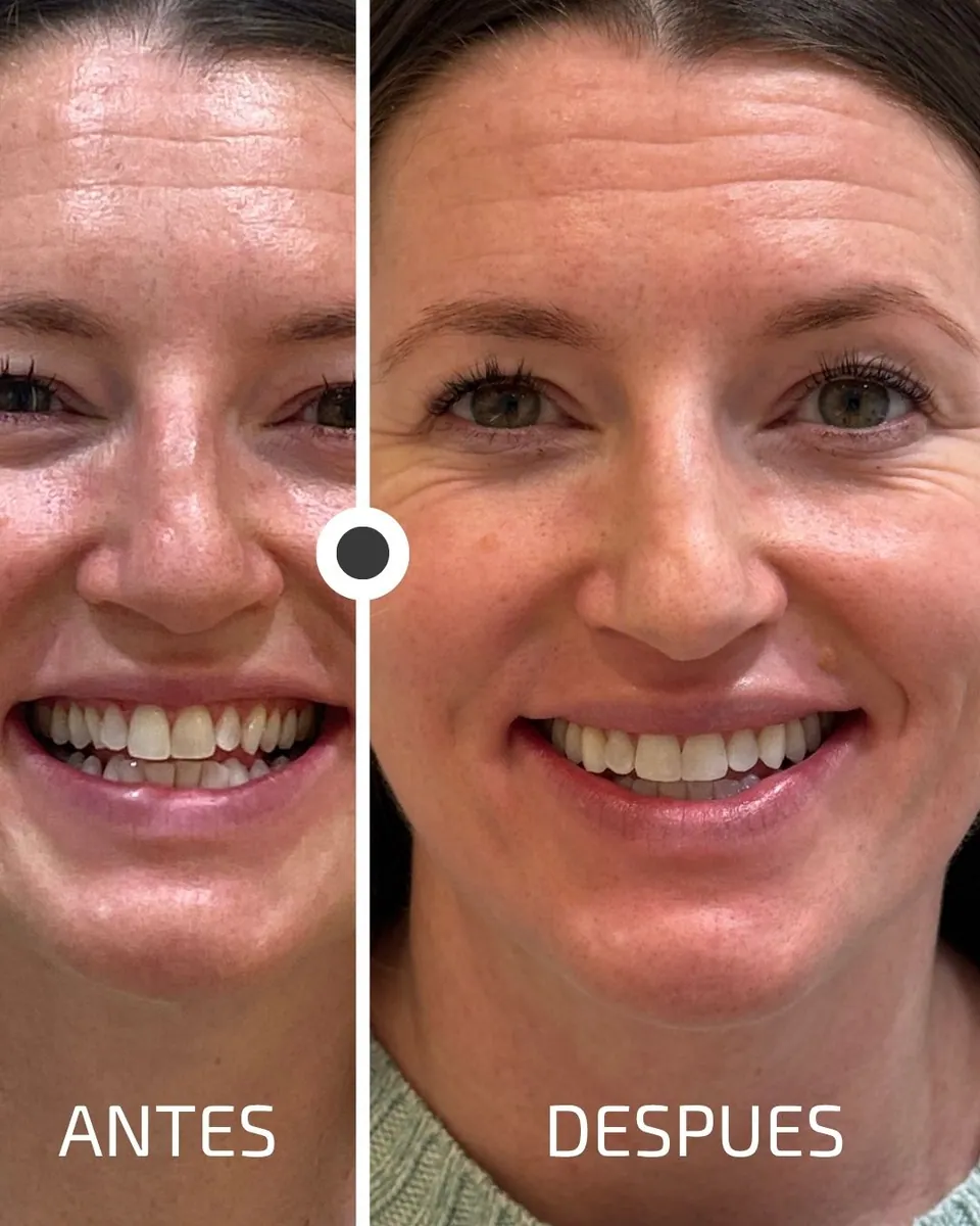 Caso real de transformación dental ByB Dental 18