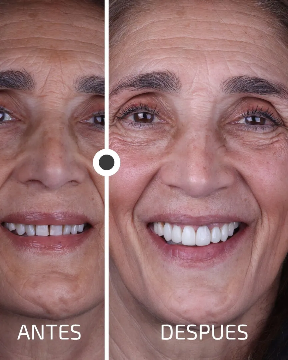 Caso real de transformación dental ByB Dental 19