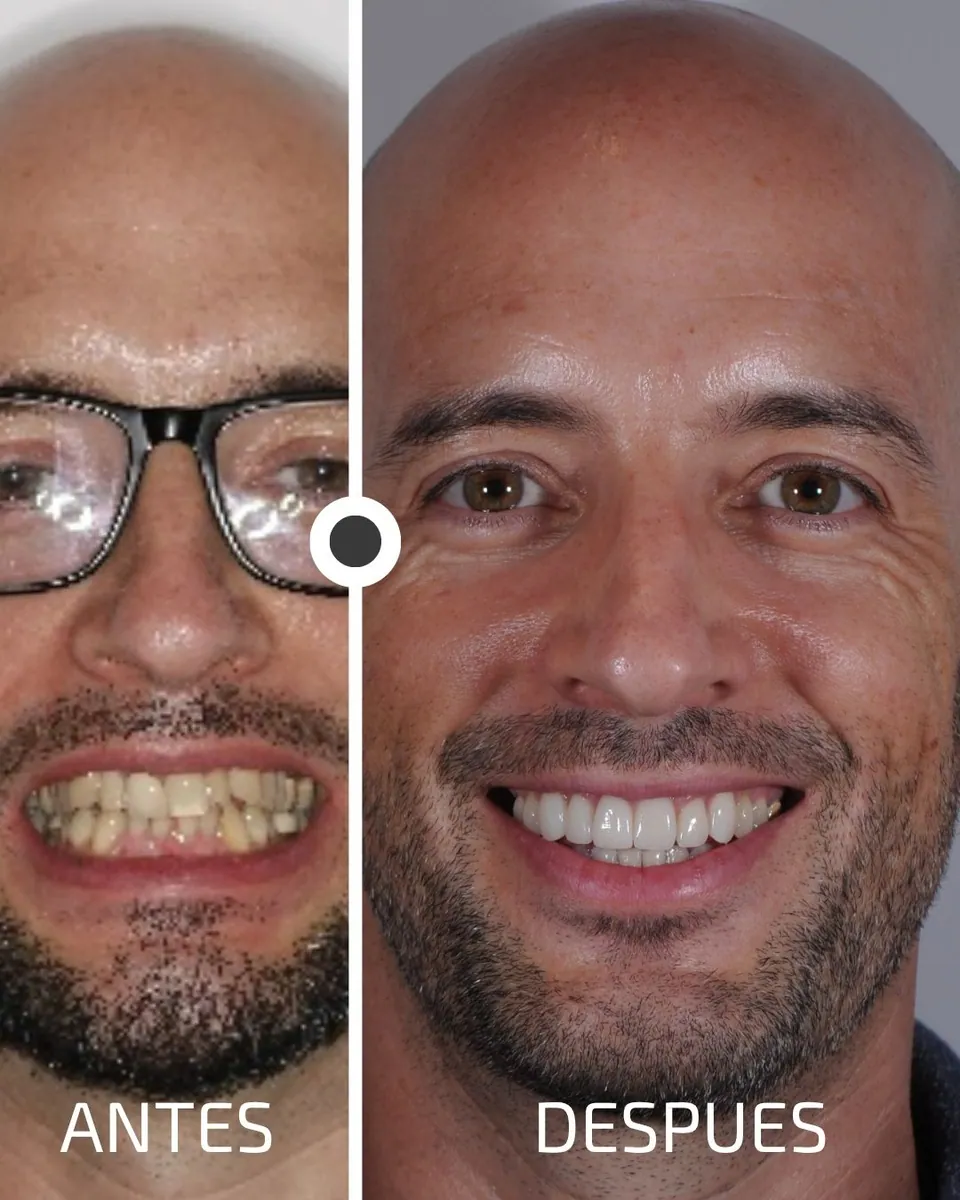 Caso real de transformación dental ByB Dental 3