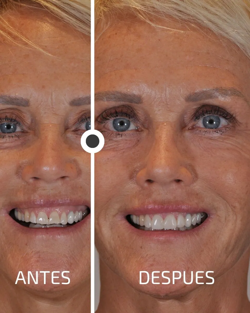 Caso real de transformación dental ByB Dental 4