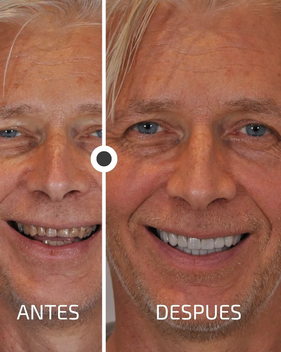 Caso real de transformación dental ByB Dental 5