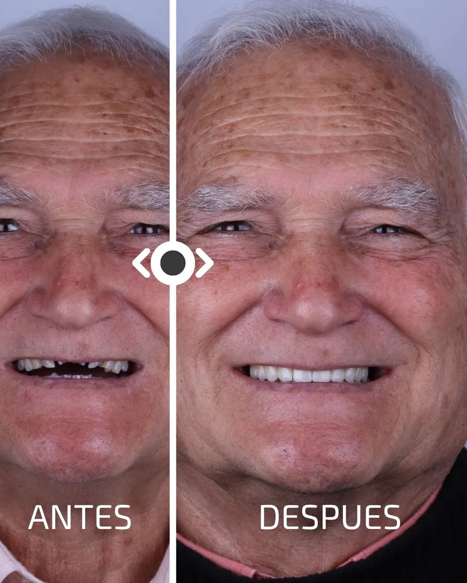 Caso real de transformación dental ByB Dental 6