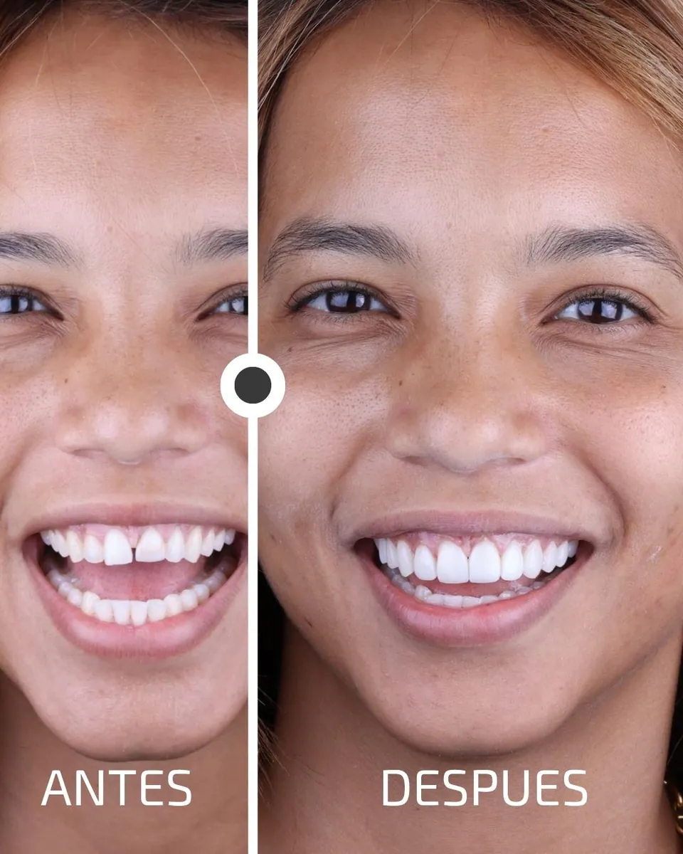 Caso real de transformación dental ByB Dental 7
