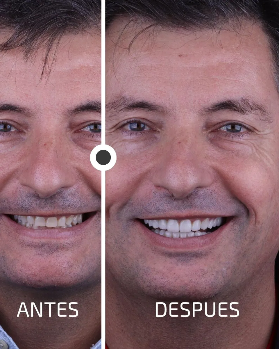 Caso real de transformación dental ByB Dental 8