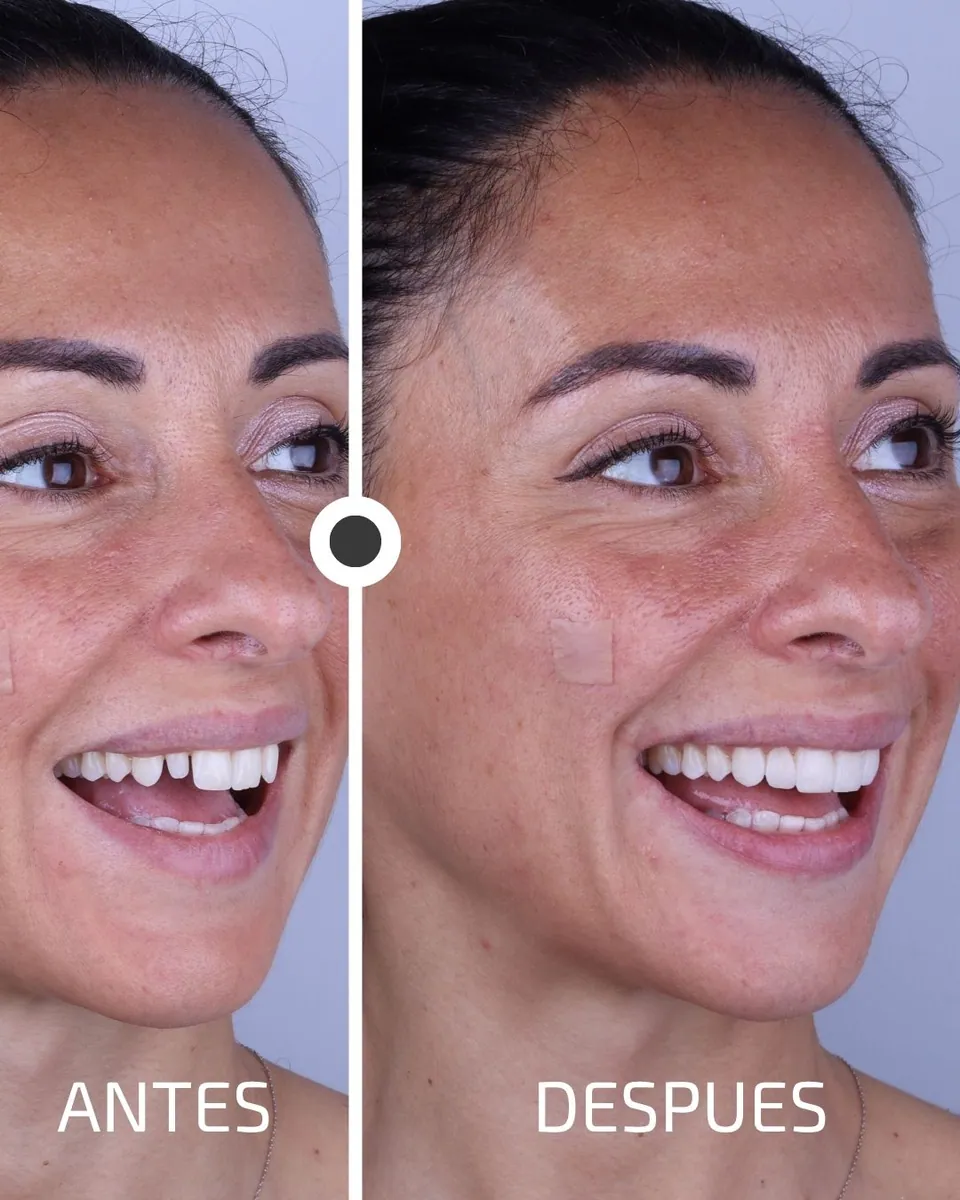 Caso real de transformación dental ByB Dental 9