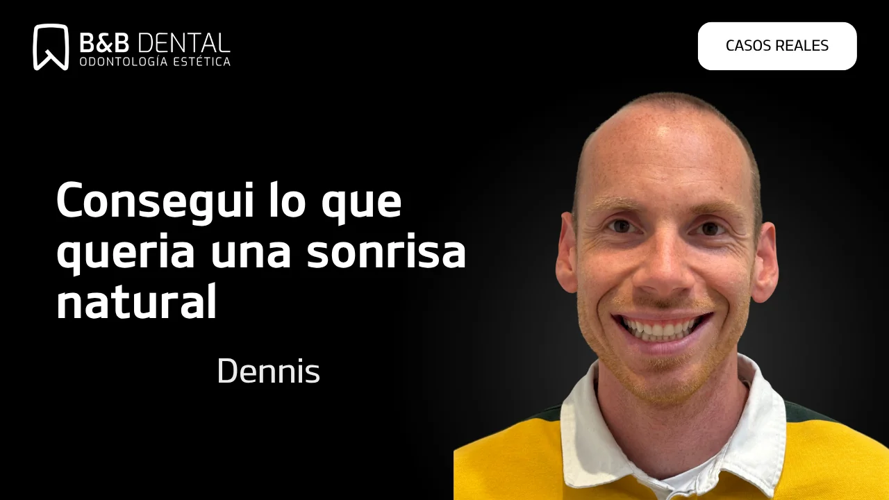 Dennis, caso real de Ortodoncia invisible y carillas de composite en ByB Dental