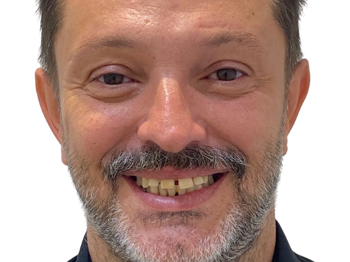Antes de un tratamiento de all-on-4 en ByB Dental