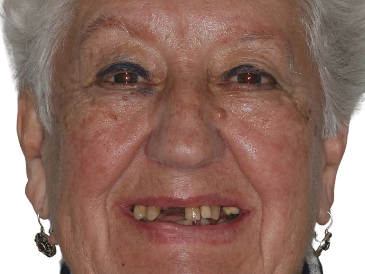 Antes de un tratamiento de all-on-4 en ByB Dental