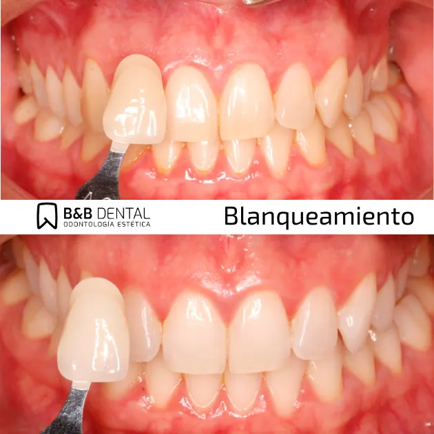 Real teeth whitening result at ByB Dental Málaga