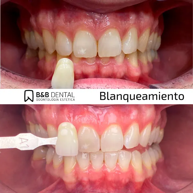 Professional teeth whitening case in Málaga