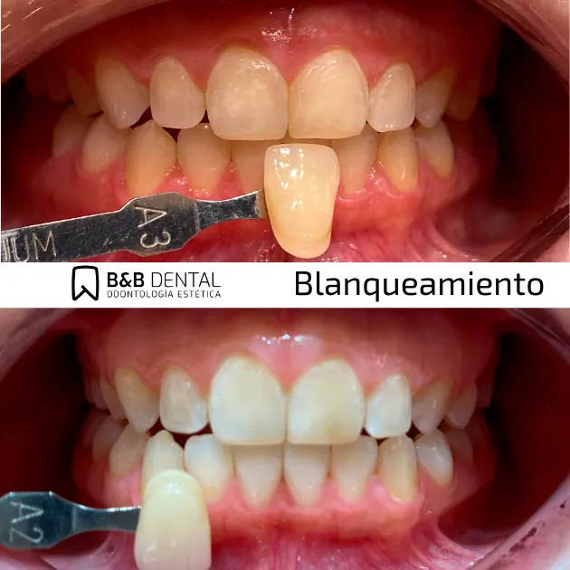 Smile after teeth whitening treatment at ByB Dental