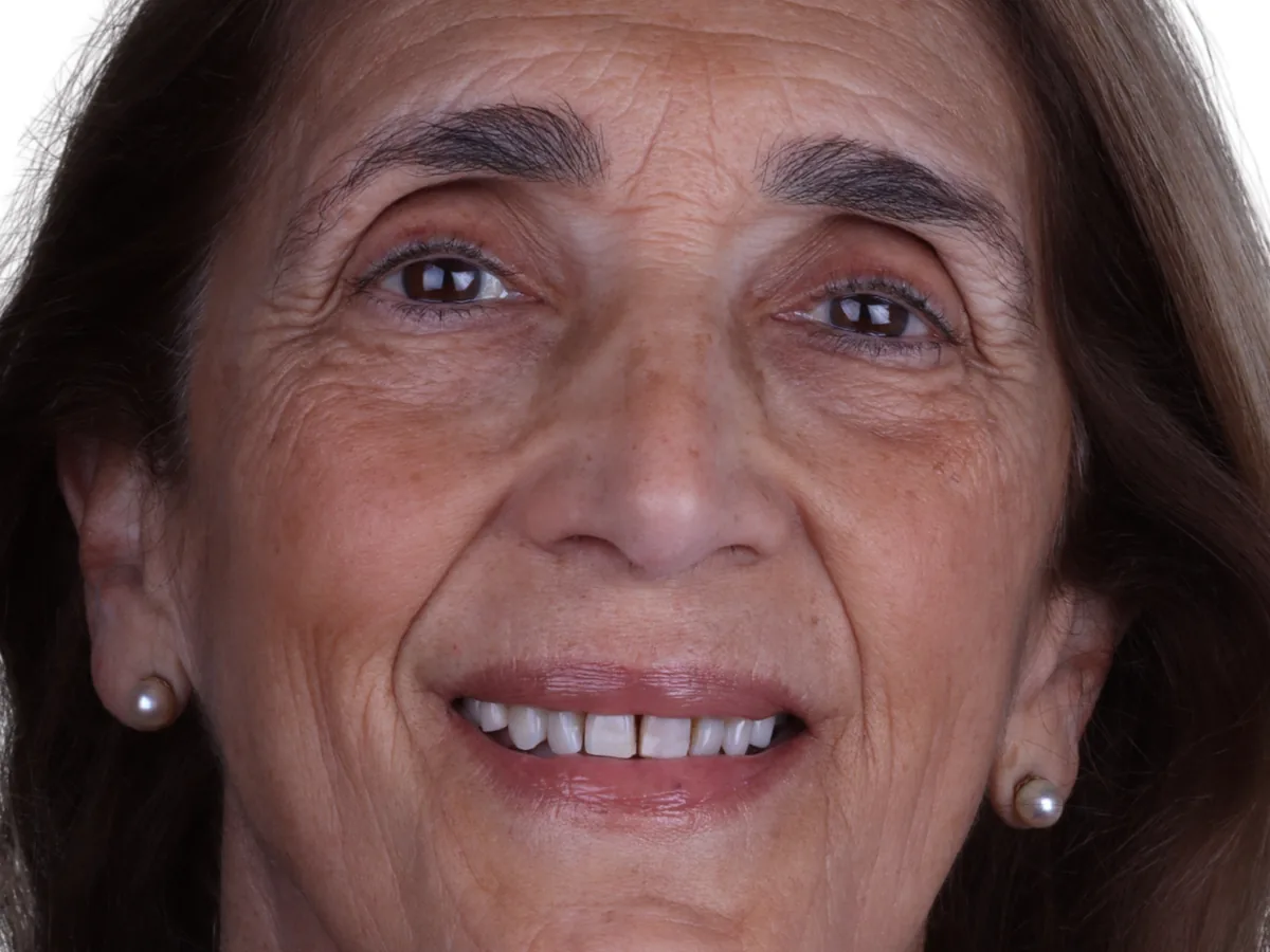 Before cosmetic dentistry in málaga treatment at ByB Dental