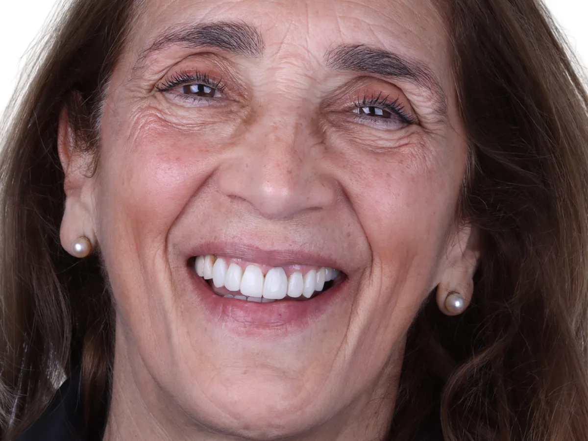 After cosmetic dentistry in málaga treatment at ByB Dental