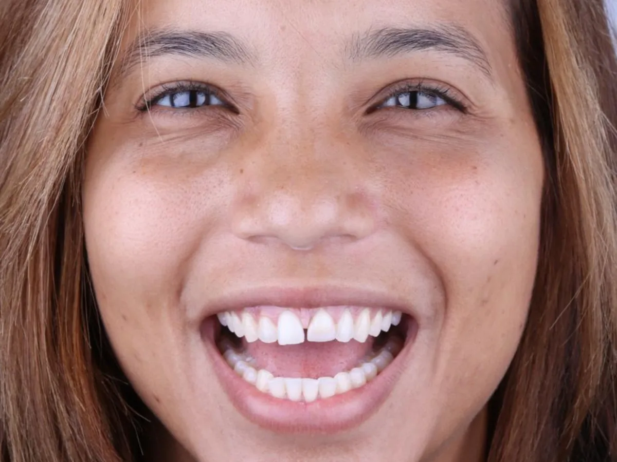 Before Idaila's veneers and smile design treatment
