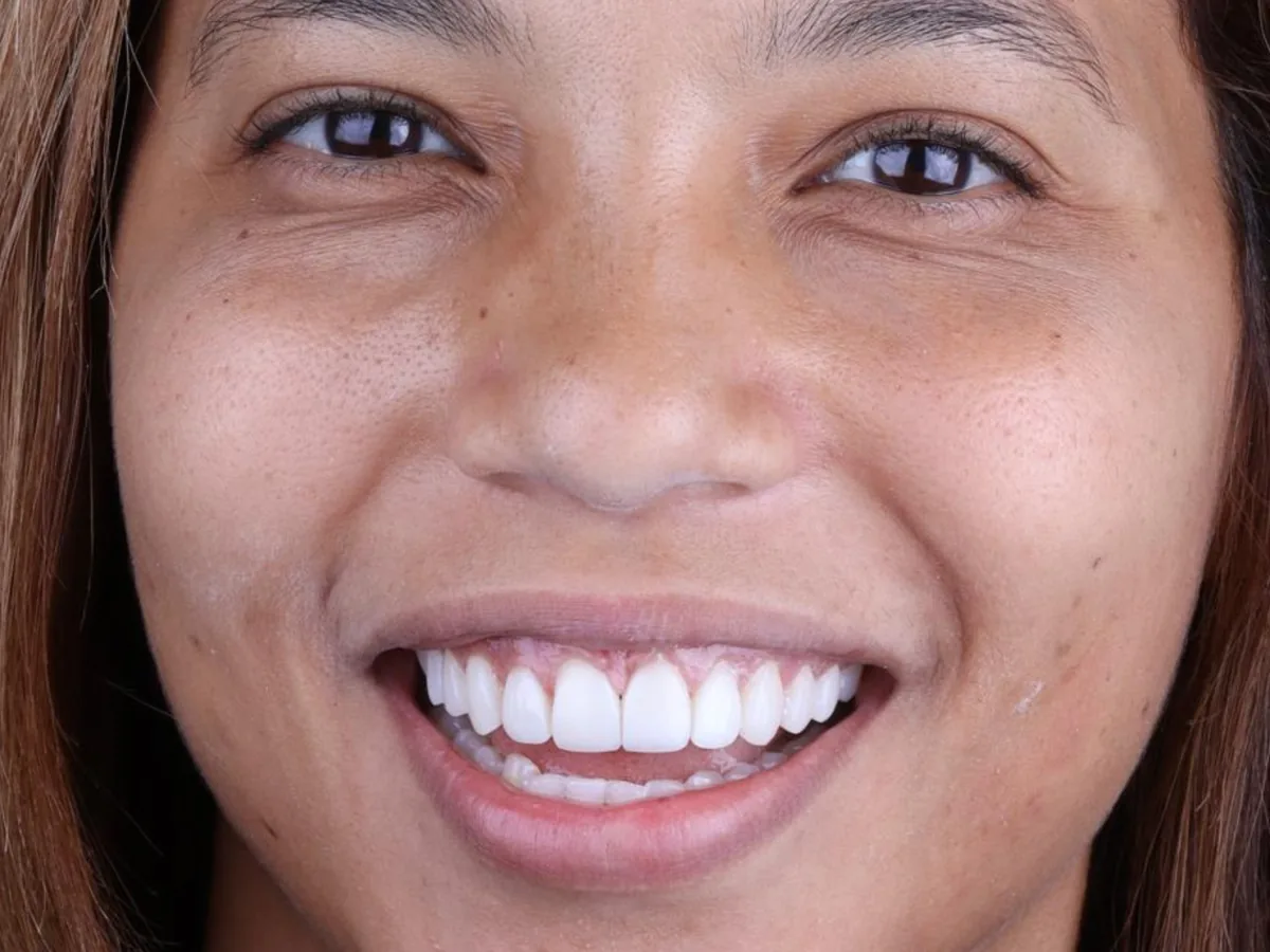 After Idaila's veneers and smile design treatment