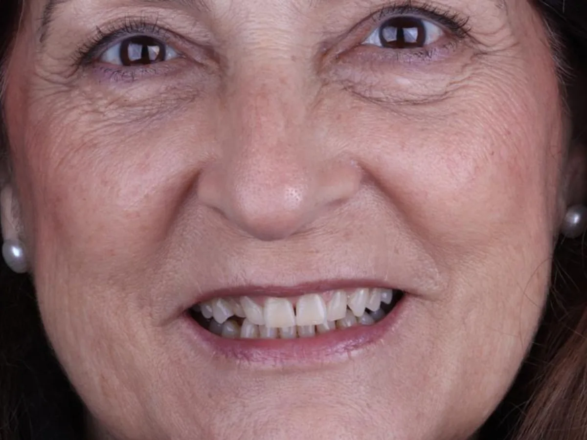 Before cosmetic dentistry in málaga treatment at ByB Dental