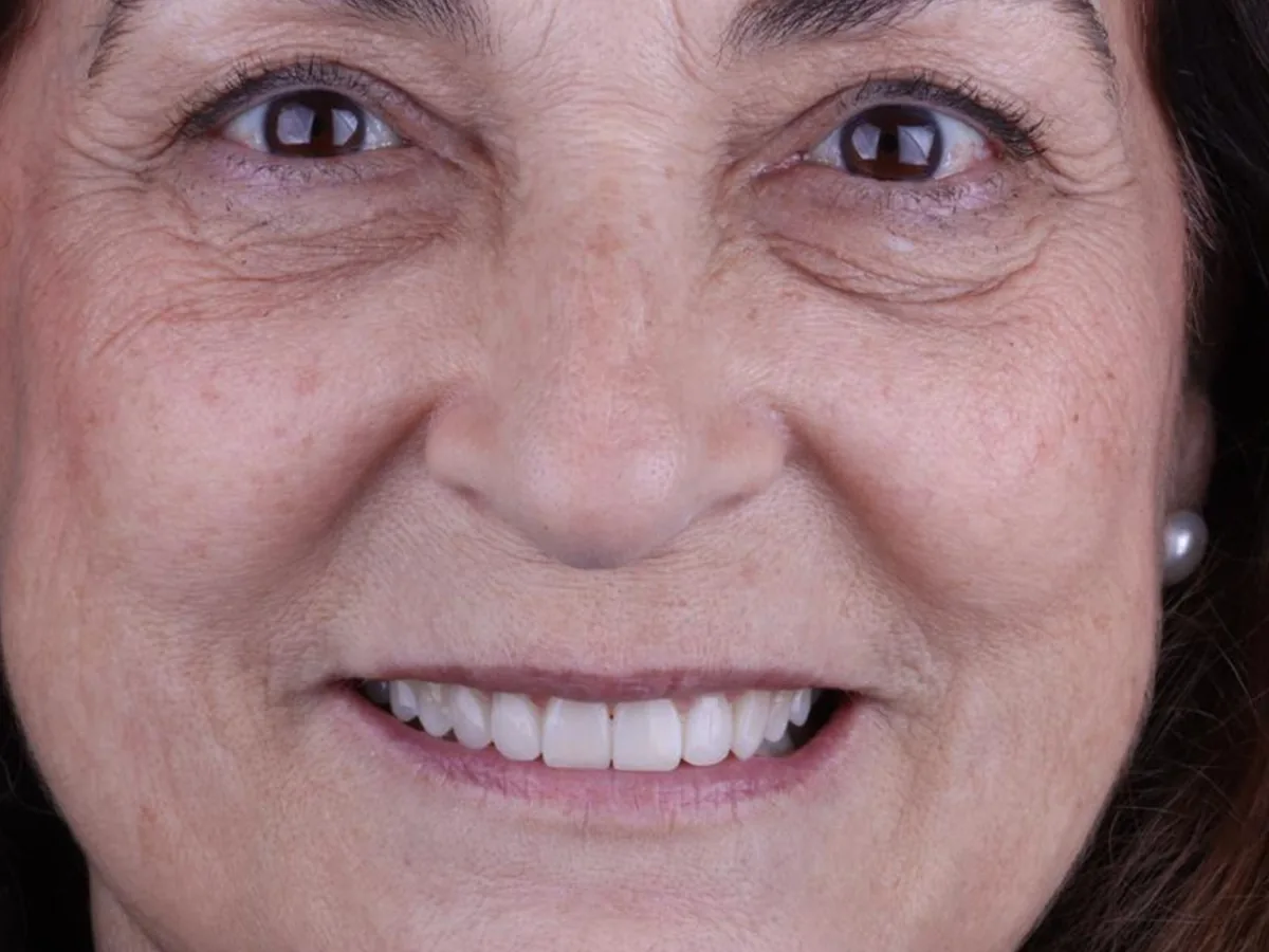 After cosmetic dentistry in málaga treatment at ByB Dental