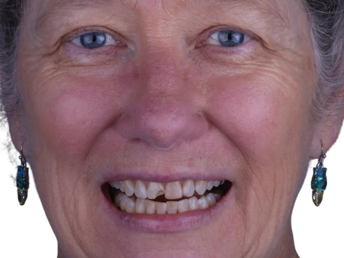 Before cosmetic dentistry in málaga treatment at ByB Dental