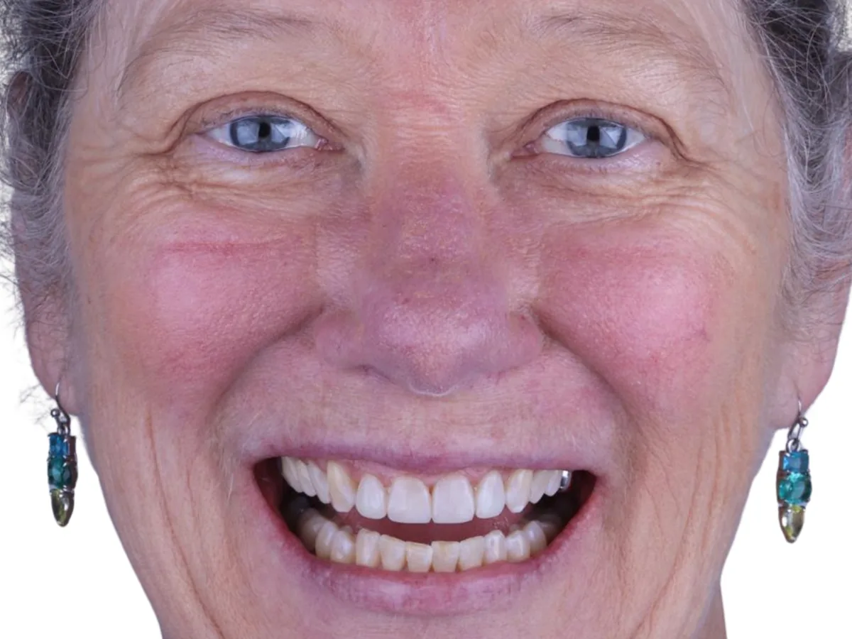 After cosmetic dentistry in málaga treatment at ByB Dental