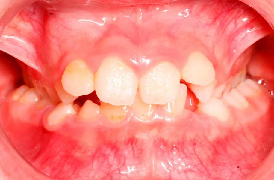 Before children's dentist in málaga treatment at ByB Dental