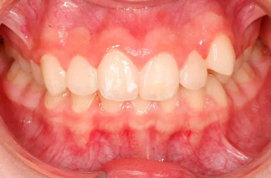 After children's dentist in málaga treatment at ByB Dental
