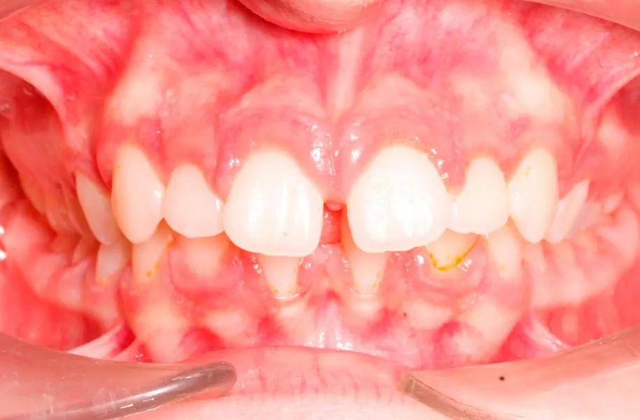 Before children's dentist in málaga treatment at ByB Dental