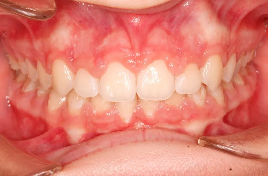 After children's dentist in málaga treatment at ByB Dental
