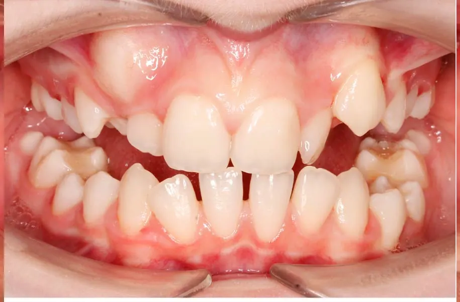 Before children's dentist in málaga treatment at ByB Dental