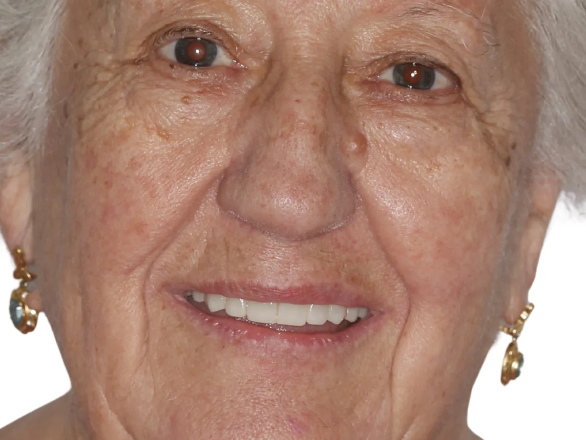 After dental implants in málaga treatment at ByB Dental