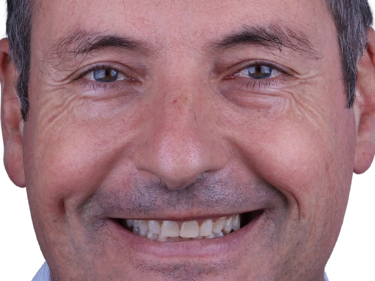 Before dental implants in málaga treatment at ByB Dental