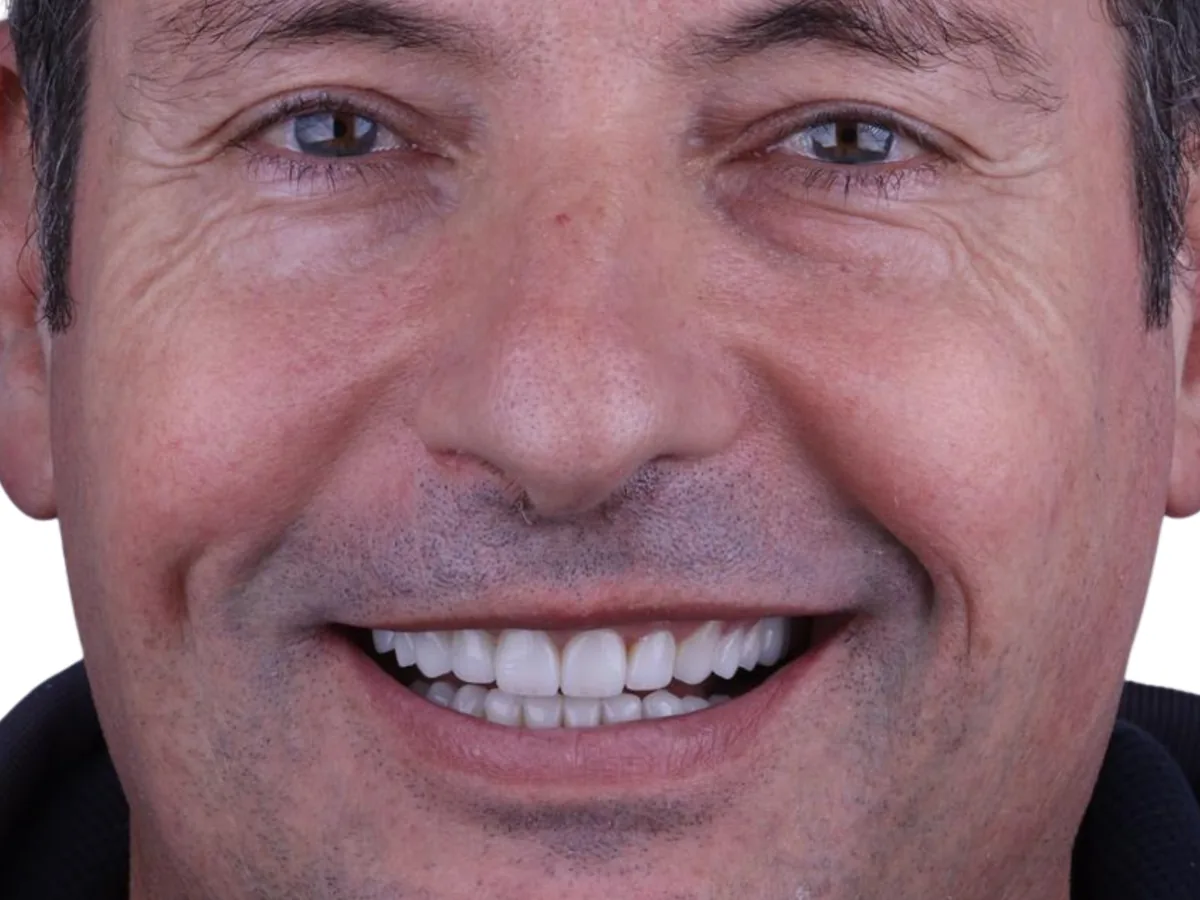 After dental implants in málaga treatment at ByB Dental