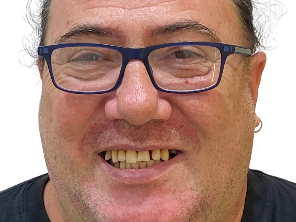 Before dental implants in málaga treatment at ByB Dental