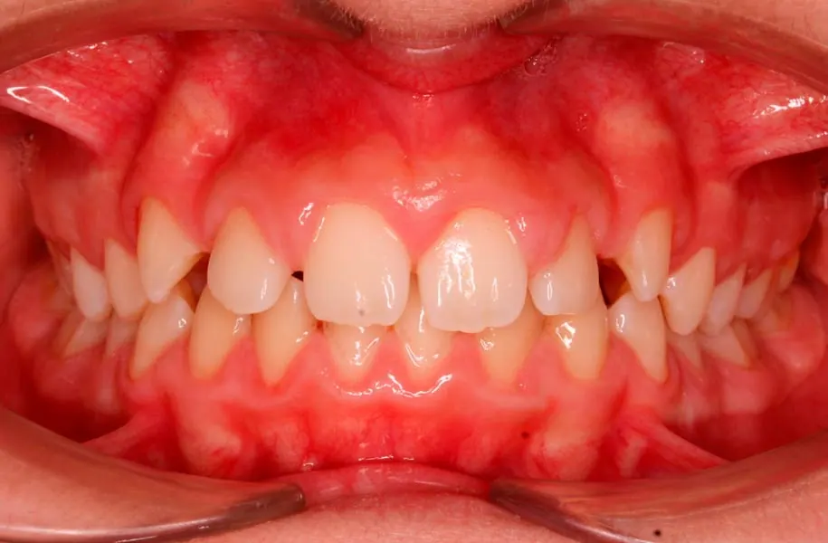 Before children's orthodontics in málaga treatment at ByB Dental